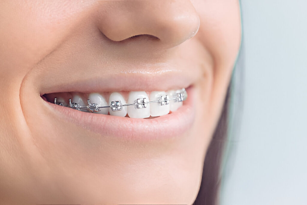 Orthodontic Care